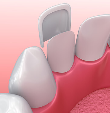 illustration of a dental veneer