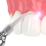 dental lasers, laser gum therapy, gum disease treatment, Colony Dental Care, Dr. James Oei, San Antonio TX dentist