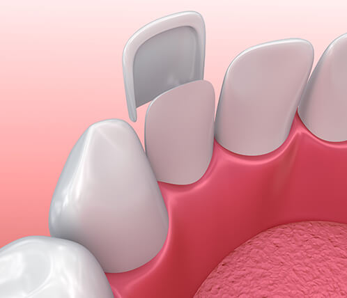 illustration of a dental veneer